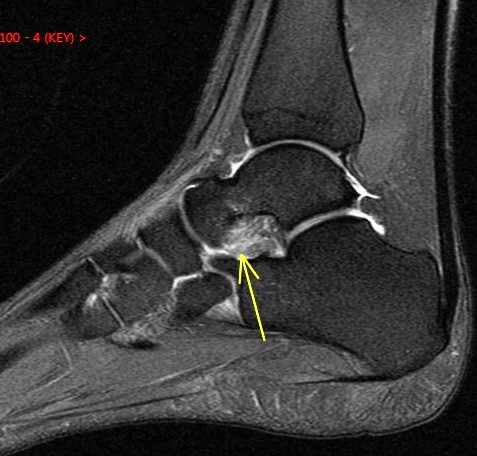 Figure 4 for case Sinus tarsi ligament sprains
